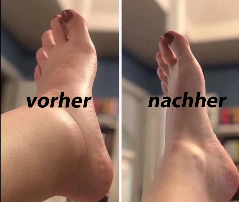 Comprex compression socks before and after